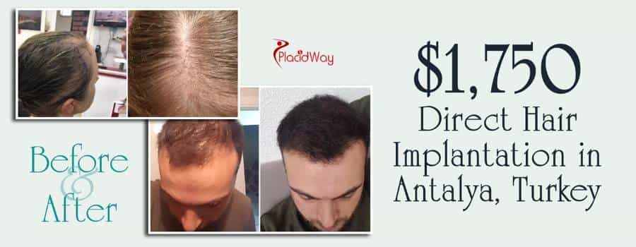 DHI Hair Transplant Cost in Antalya, Turkey